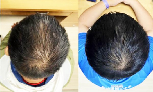 Scientists invent a plant-based serum that is proven to regrow hair in weeks